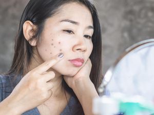 Dark Spot Adalah Bercak Gelap pada Kulit, Begini Cara Menghilangkannya!