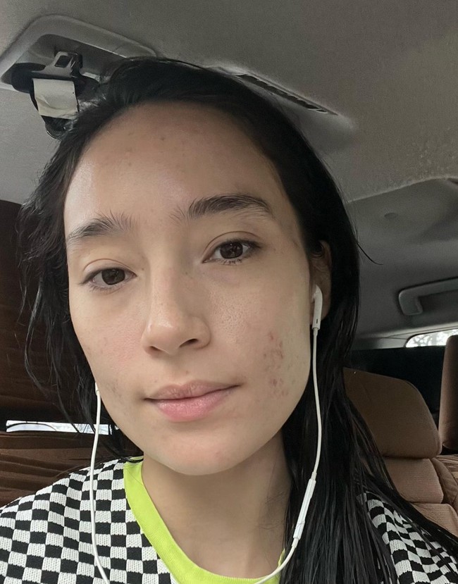 Dalam keterangan unggahannya Tatjana mengaku sudah mengalami permasalahan jerawat selama lebih dari 10 tahun. Perjalanannya untuk sembuh dari jerawat itu tak mudah, harus melewati saat-saat surut ketika jerawatnya mulai mereda, dan saat-saat naik, ketika jerawat-jerawatnya kembali muncul. Foto: Instagram/@tatjanasaphira