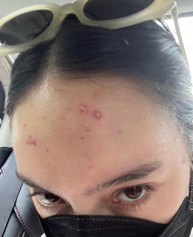 Tatjana mengungkapkan bahwa yang terpenting adalah bisa menerima dan mencintai diri sendiri dengan segala kekurangannya. Hal itu yang kemudian ia coba untuk buktikan dengan tetap percaya diri mengunggah foto-foto wajahnya saat tengah berjerawat. Foto: Instagram/@tatjanasaphira