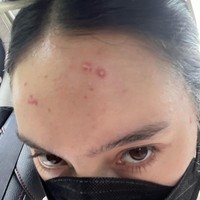 Tatjana mengungkapkan bahwa yang terpenting adalah bisa menerima dan mencintai diri sendiri dengan segala kekurangannya. Hal itu yang kemudian ia coba untuk buktikan dengan tetap percaya diri mengunggah foto-foto wajahnya saat tengah berjerawat. Foto: Instagram/@tatjanasaphira