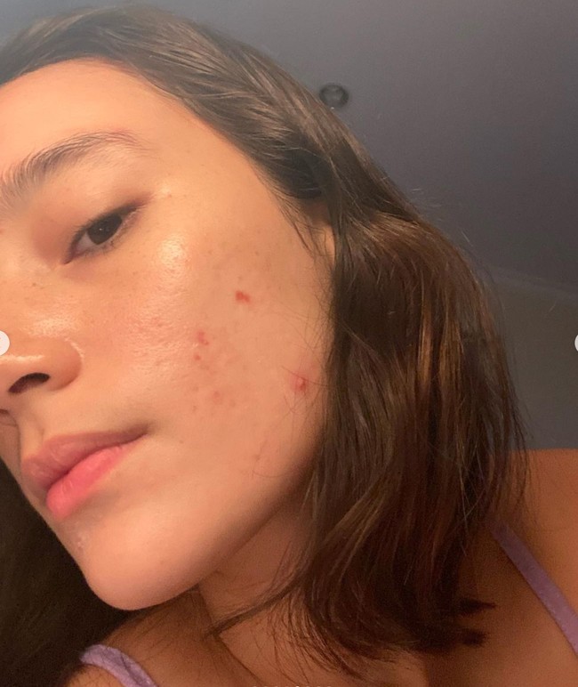 Tampil polos tanpa pulasan makeup, Tatjana tetap percaya diri memamerkan wajahnya yang berjerawat. Meski berjerawat namun tak sedikit yang memujinya tetap cantik. Foto: Instagram/@tatjanasaphira