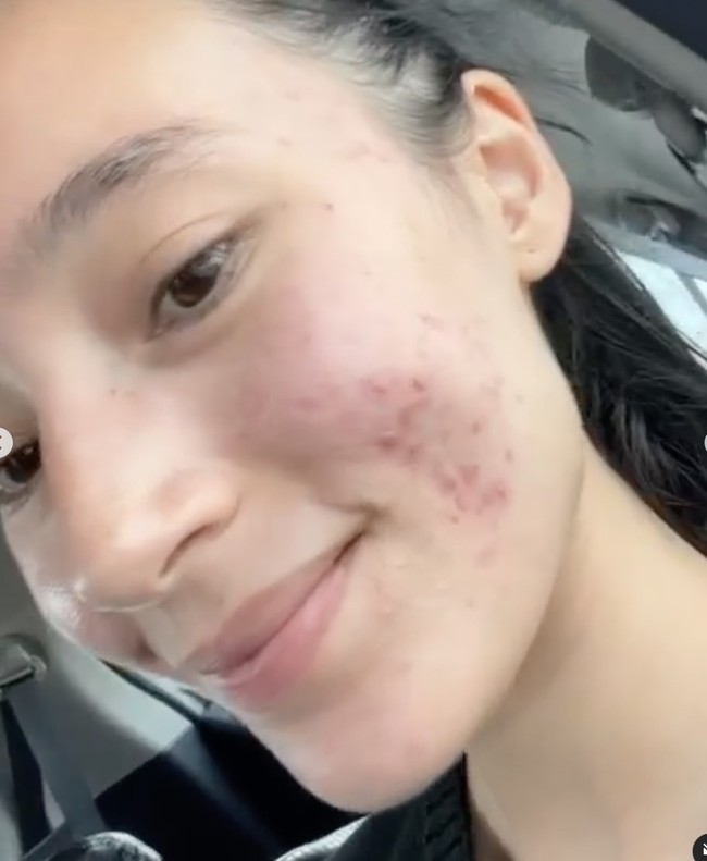 Jerawat sendiri merupakan salah satu permasalahan kulit yang banyak dialami oleh pria maupun wanita. Namun alih-alih menutupinya dengan makeup, Tatjana lebih memilih untuk memamerkan wajah aslinya yang tetap cantik tanpa pulasan makeup. Foto: Instagram/@tatjanasaphira