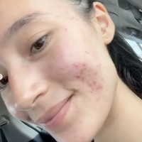 Jerawat sendiri merupakan salah satu permasalahan kulit yang banyak dialami oleh pria maupun wanita. Namun alih-alih menutupinya dengan makeup, Tatjana lebih memilih untuk memamerkan wajah aslinya yang tetap cantik tanpa pulasan makeup. Foto: Instagram/@tatjanasaphira
