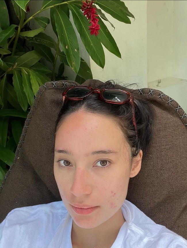 Kini jerawat di wajah Tatjana pun perlahan sudah mulai membaik dan tak sebanyak dulu. Foto: Instagram/@tatjanasaphira