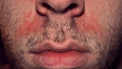 Ilustrasi dermatitis seboroik.