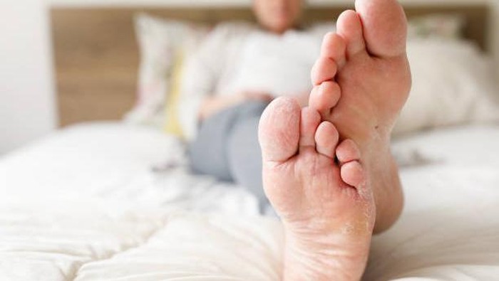 Athletes Foot