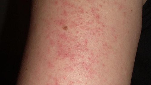 Ilustrasi keratosis pilaris.