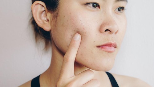 Problems with acne and scar on the female skin.