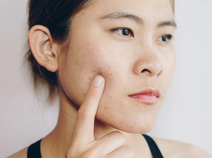 Problems with acne and scar on the female skin.