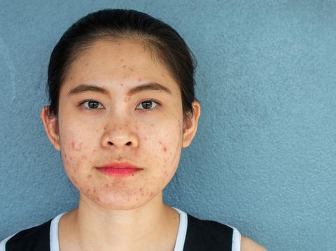 Inflamed acne consists of swelling, redness, and pores that are deeply clogged with bacteria, oil, and dead skin cells.
