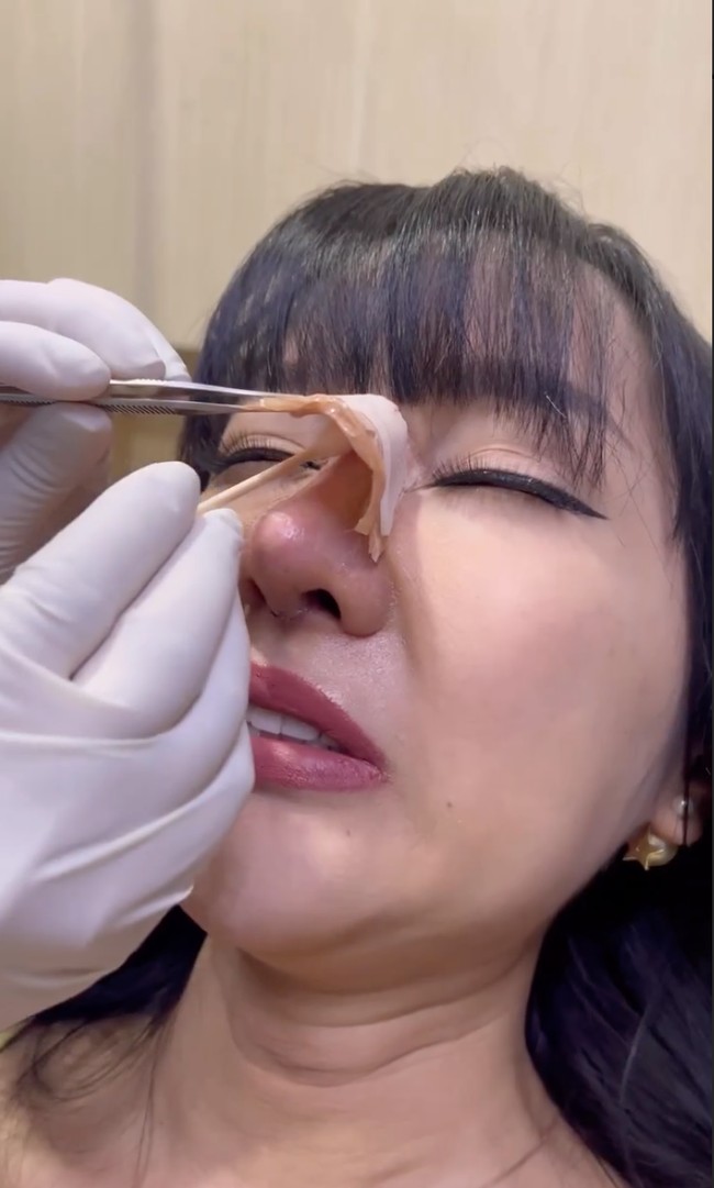 Lucinta Luna kembali melakukan operasi plastik pada bagian hidungnya. Setelah beberapa hari akhirnya perban di hidungnya bisa dilepas dan hidung barunya pun sudah bisa terlihat dengan jelas. Foto: Instagram/@lucintaluna_manjalita