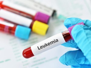 Leukemia Jadi Jenis Kanker Terbanyak pada Anak RI, IDAI Bicara Pemicunya