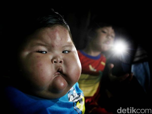 Potret Kenzie Si Bayi Viral Obesitas di Bekasi, Umur Setahun Beratnya 27 Kg