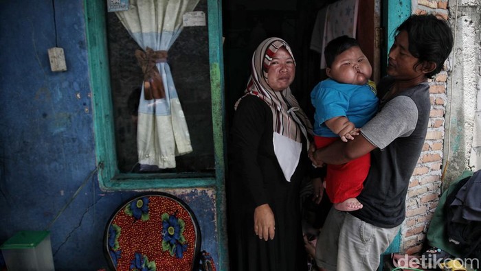 Kenzie Si Bayi Viral Obesitas, 1 Tahun Beratnya 27 Kg Viral bayi bernama Kenzie, punya bobot 27 kilogram di usia satu tahun. Ibunda Kenzie, Pitriah mengungkapkan berat badan anaknya memang berlebih sejak ia lahir.
Akibat obesitas yang dialaminya, tumbuh kembang Kenzie terganggu. Tidak seperti bayi seusianya, Kenzie belum bisa berdiri tegak.