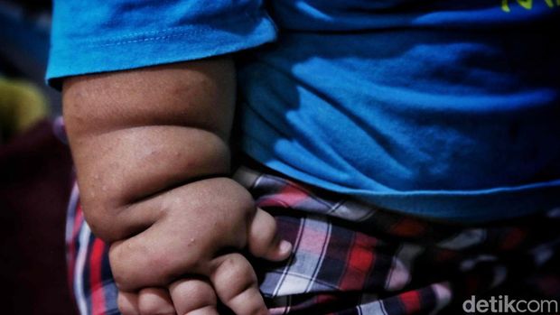 Kenzie Si Bayi Viral Obesitas, 1 Tahun Beratnya 27 Kg Viral bayi bernama Kenzie, punya bobot 27 kilogram di usia satu tahun. Ibunda Kenzie, Pitriah mengungkapkan berat badan anaknya memang berlebih sejak ia lahir.Akibat obesitas yang dialaminya, tumbuh kembang Kenzie terganggu. Tidak seperti bayi seusianya, Kenzie belum bisa berdiri tegak.