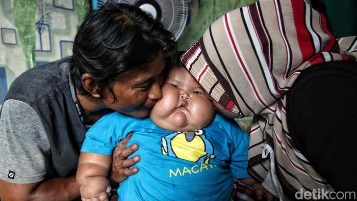 Viral Bayi Bekasi Umur 16 Bulan Punya BB 27 Kg, Begini Kondisinya