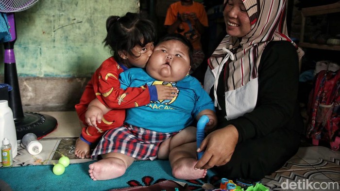 Bayi Obesitas di Bekasi Punya BB 27 Kg Akan Jalani Pemeriksaan Hormon