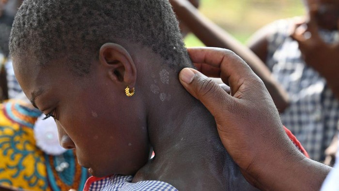 A doctor consults children during a leprosy screening campaign in village of Djougbosso, near Adzope, on January 25, 2023. - Listed by the WHO as one of the 20 neglected tropical diseases (NTDs), leprosy is transmitted from a sick person to healthy person. The microbe multiplies very slowly, and the incubation period can last up to 5 years. The first symptoms show spots, then gradually eat away at desensitized limbs. (Photo by Issouf SANOGO / AFP) (Photo by ISSOUF SANOGO/AFP via Getty Images)