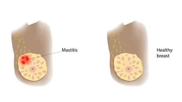 Ilustrasi payudara yang sehat dan mastitis.