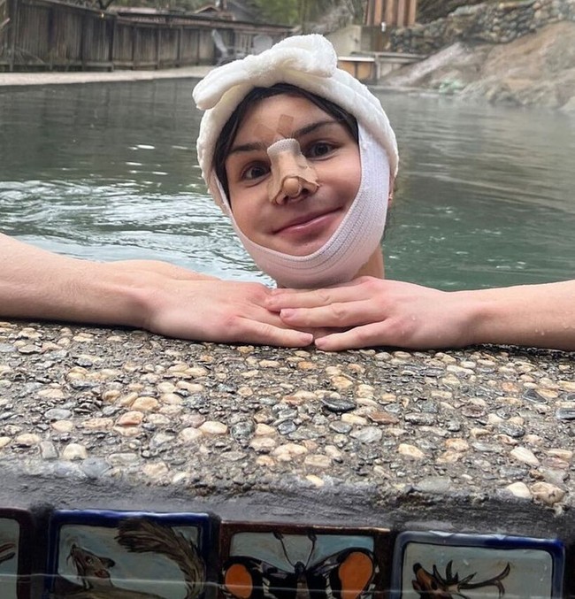 Transgender wanita 26 tahun itu telah menjalani operasi feminisasi wajah pada awal tahun ini. Di mana bagian tulang wajahnya dipotong agar menghasilkan karakter muka yang lebih lembut. Foto: Instagram/@dylanmulvaney