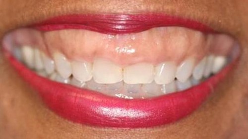 Contoh kondisi gummy smile.