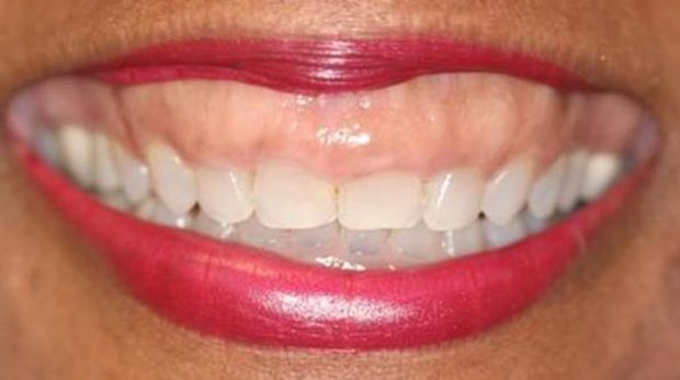 Contoh kondisi gummy smile.