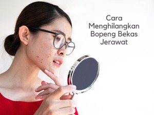 10 Cara Menghilangkan Bopeng Bekas Jerawat, Dijamin Ampuh!