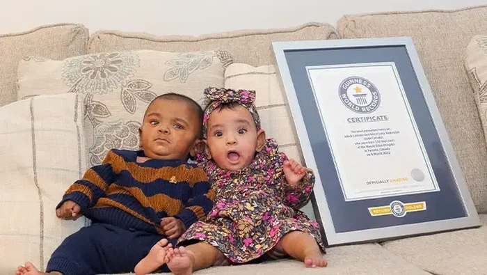 Bayi kembar paling prematur di dunia