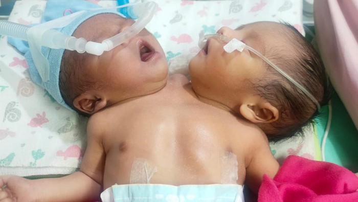 Geva dan Gama bayi kembar siam yang lahir di Jakarta Timur (Dok. Pribadi)
