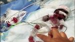 8 Foto Bayi Kembar Paling Prematur di dunia, Rayakan Ulang Tahun yang Pertama