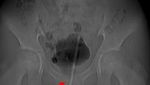 5 Foto X-ray Bikin Merinding, Barbel Nyangkut di Anus sampai Penampakan Susuk