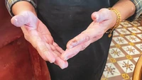Bukti kalau chef Gaik Lean bekerja berat di dapur. Tangannya sampai luka-luka karena ia memasak banyak hidangan.