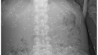 Diprediksi ada sekitar 800 jarum susuk yang bersarang di tubuh wanita ini. Radiografi perut dari pasien yang sama menunjukkan jarum berada paling banyak di area panggul. (Foto: Journal of Radiology Case Reports)  