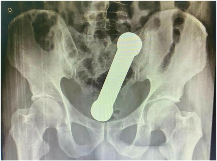 x-ray nyangkut di anus