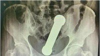 Seorang pria di Brasil mengeluh sakit perut setelah barbel nyangkut di anusnya selama dua hari. (Foto: International Journal of Surgery Case Reports)
