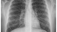 Foto X-ray remaja berusia 17 tahun di Kanada yang mengalami kondisi langka popcorn lung akibat kebiasaan menghisap vape. (Foto: Canadian Medical Association Journal)