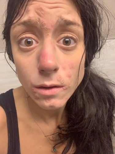 Cara Tatarelli, wanita yang overdosis 5 kali
