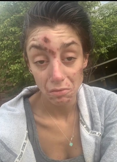 Cara Tatarelli, wanita yang overdosis 5 kali Cara Tatarelli, wanita yang overdosis 5 kali