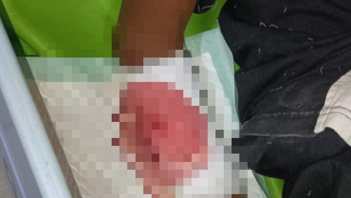 Penampakan lengan anak SD di Blitar dibacok temannya