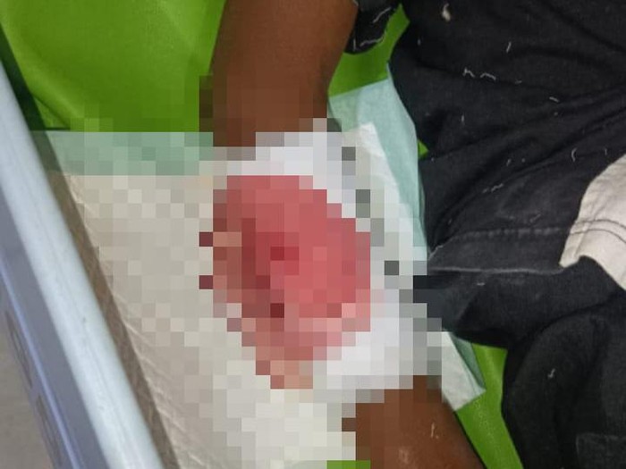 Penampakan lengan anak SD di Blitar dibacok temannya