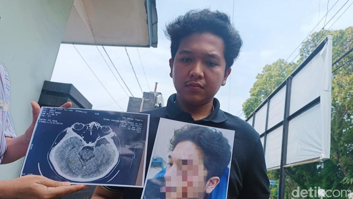 Teuku Shehan, mahasiswa Kedokteran UISU saat menunjukkan foto luka yang dialaminya akiabat dianiaya taruna akmil. (Goklas Wisely/detikSumut)
