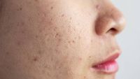 Dok, Gimana Cara Cepat Enyahkan Bekas Jerawat yang Menghitam?