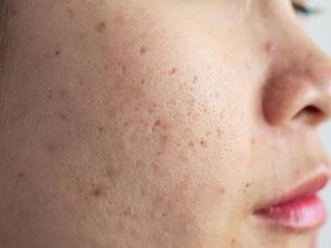Gaduh Pakai Masker Bisa Bikin Bopeng, Memang Apa Kaitannya? Dokter Bilang Gini