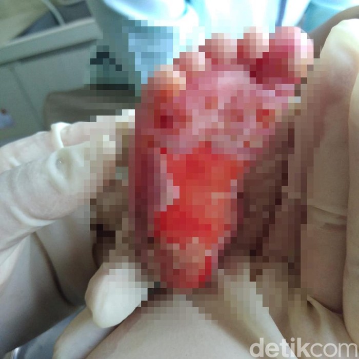 Kondisi bayi dugaan malpraktik di RS Mitra Medika di Medan.