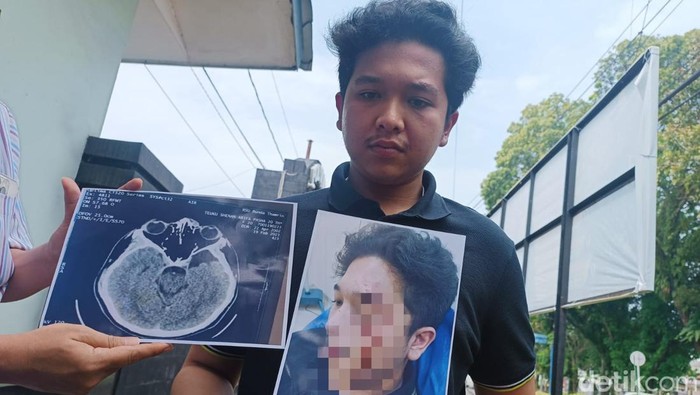 Teuku Shehan, mahasiswa FK UISU saat menunjukkan foto luka yang dialaminya akibat dianiaya Taruna Akmil berinisial MZE, anak Kasat Narkoba Polresta Deli Serdang Kompol Zulkarnain.