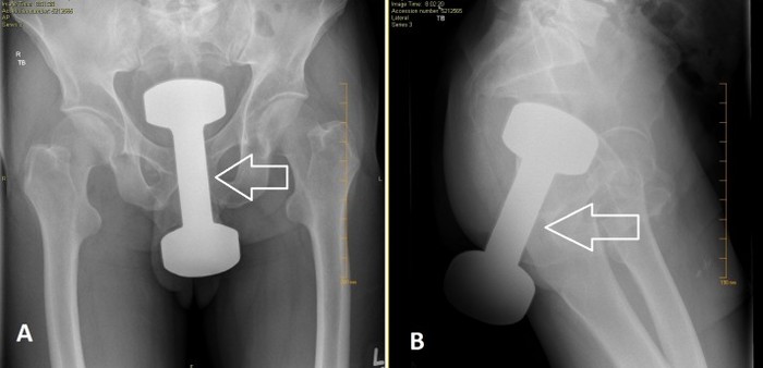 X-ray perlihatkan momen dumbell masuk dubur