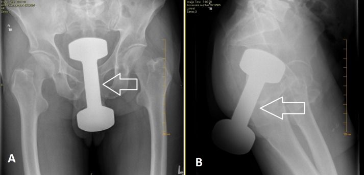 Foto x-ray X-ray perlihatkan momen dumbell masuk dubur
