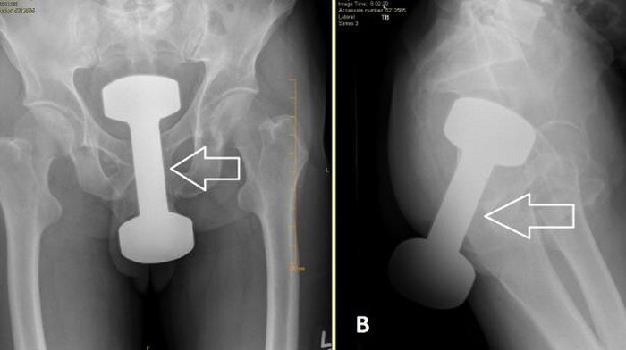 X-ray perlihatkan momen dumbell masuk dubur