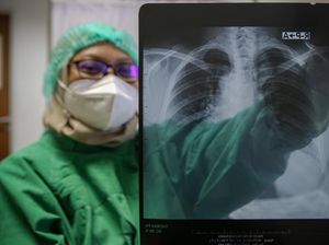 75 Persen Kasus TBC di RI Hantui 3 Wilayah Ini