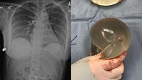 Dokter Heran, Ini Kronologi Wanita Selamat dari Tembakan Berkat Implan Payudara